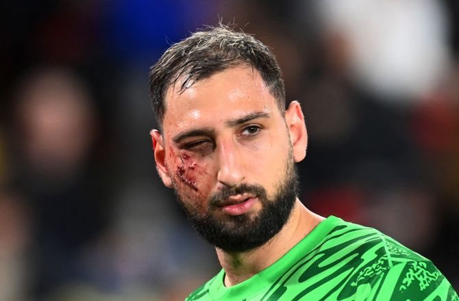 Ligue 1 -Donnarumma skal undersøges efter flænset ansigt